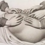 Почему врачи предпочитают кесарево сечение