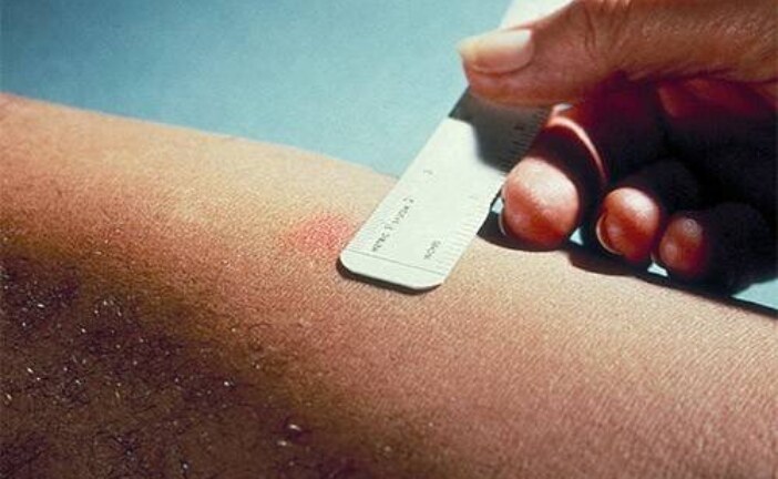Проба Манту перестает быть монополистом
