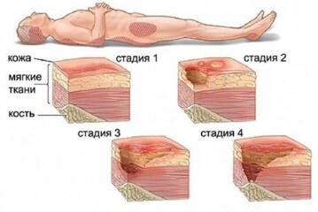 Что такое пролежни и как с ними бороться