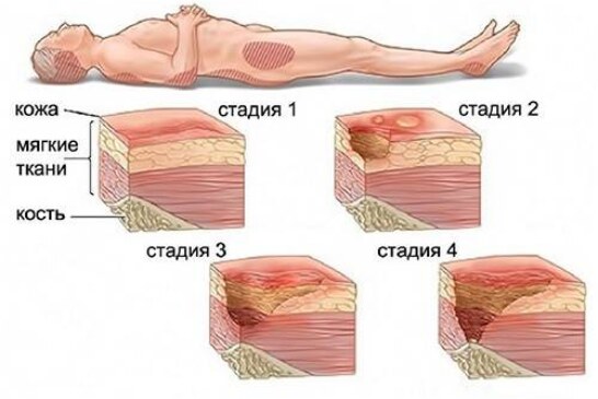 Что такое пролежни и как с ними бороться