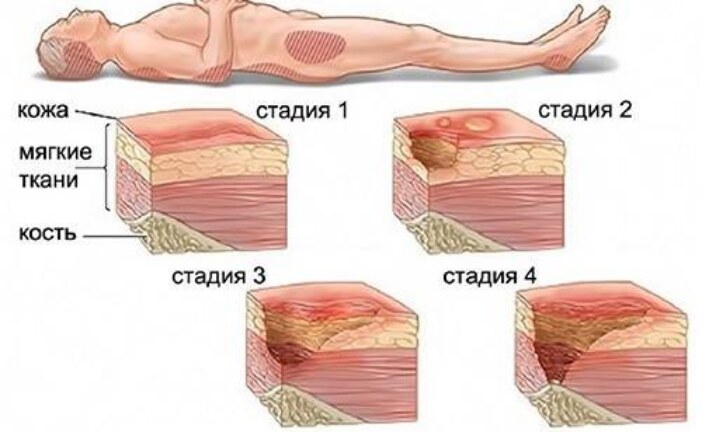 Что такое пролежни и как с ними бороться