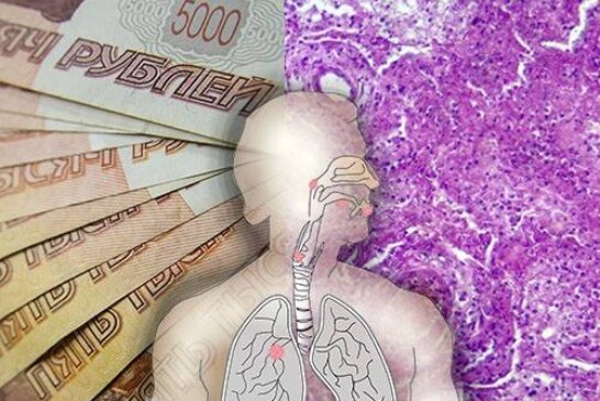 Большинство россиян считает лечение рака легкого слишком дорогим и поэтому малодоступным