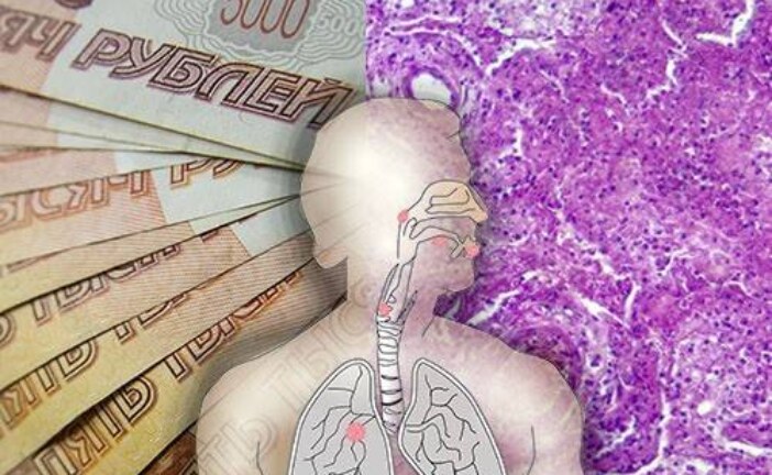 Большинство россиян считает лечение рака легкого слишком дорогим и поэтому малодоступным