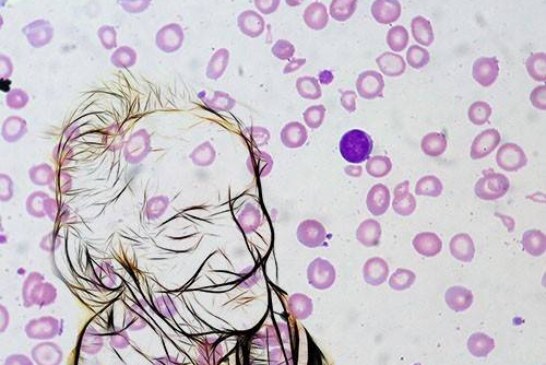 Анемию связали с повышенным риском развития деменции
