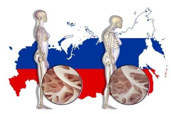 1 перелом в 3 минуты. Последствия остеопороза в России станут тяжелее, если не принять меры