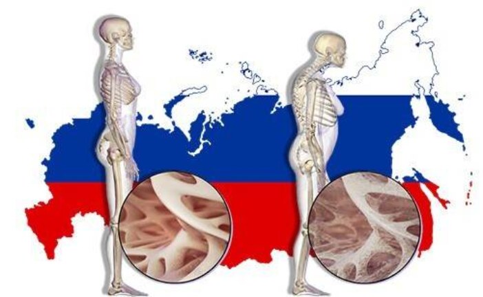 1 перелом в 3 минуты. Последствия остеопороза в России станут тяжелее, если не принять меры